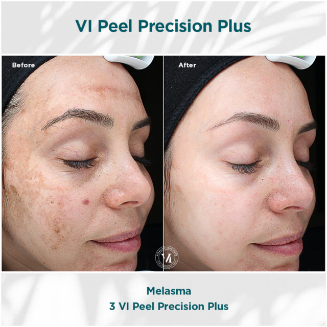 VI peel charlotte